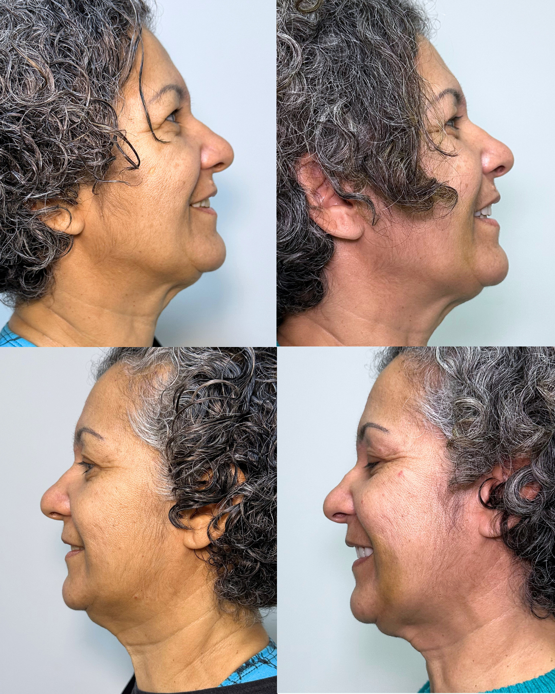 Antes e Depois — Prótese Fixa