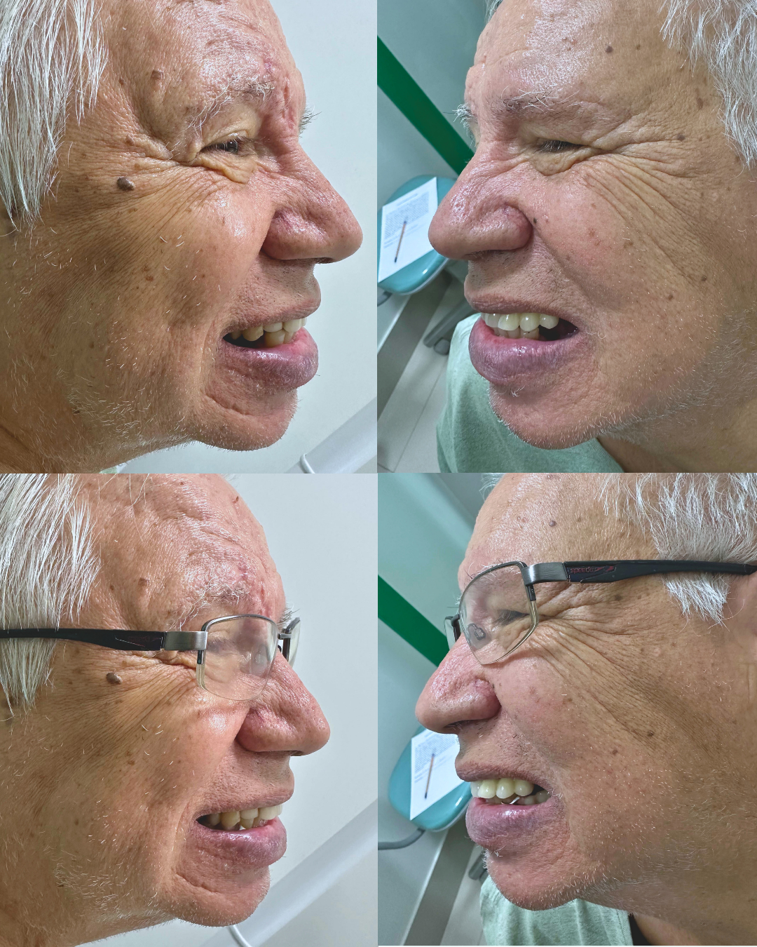Antes e Depois — Prótese Removível